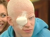 Darnell told to wear eye patch